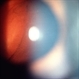 Intermediate Uveitis